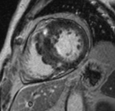 자기공명영상 (MRI, magnetic resonance image)