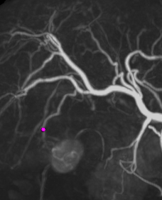경동맥화학 색전술 (TACE : TransArterial ChemoEmbolization)