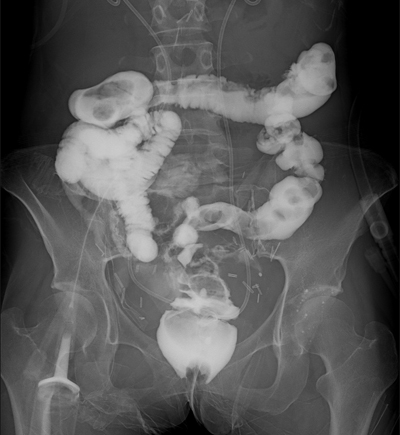 위장관 조영술 (GI Fluoroscopy)