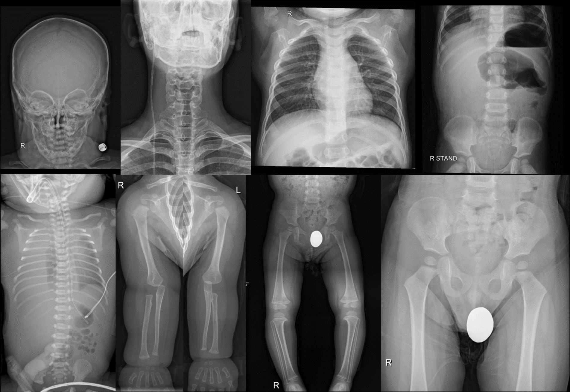 일반 X-선 촬영 (Plain Radiography)