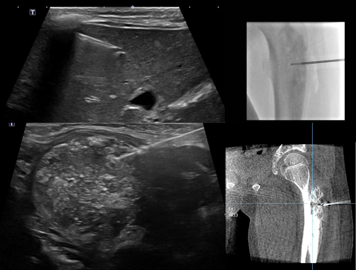 조직 생검 (Biopsy)