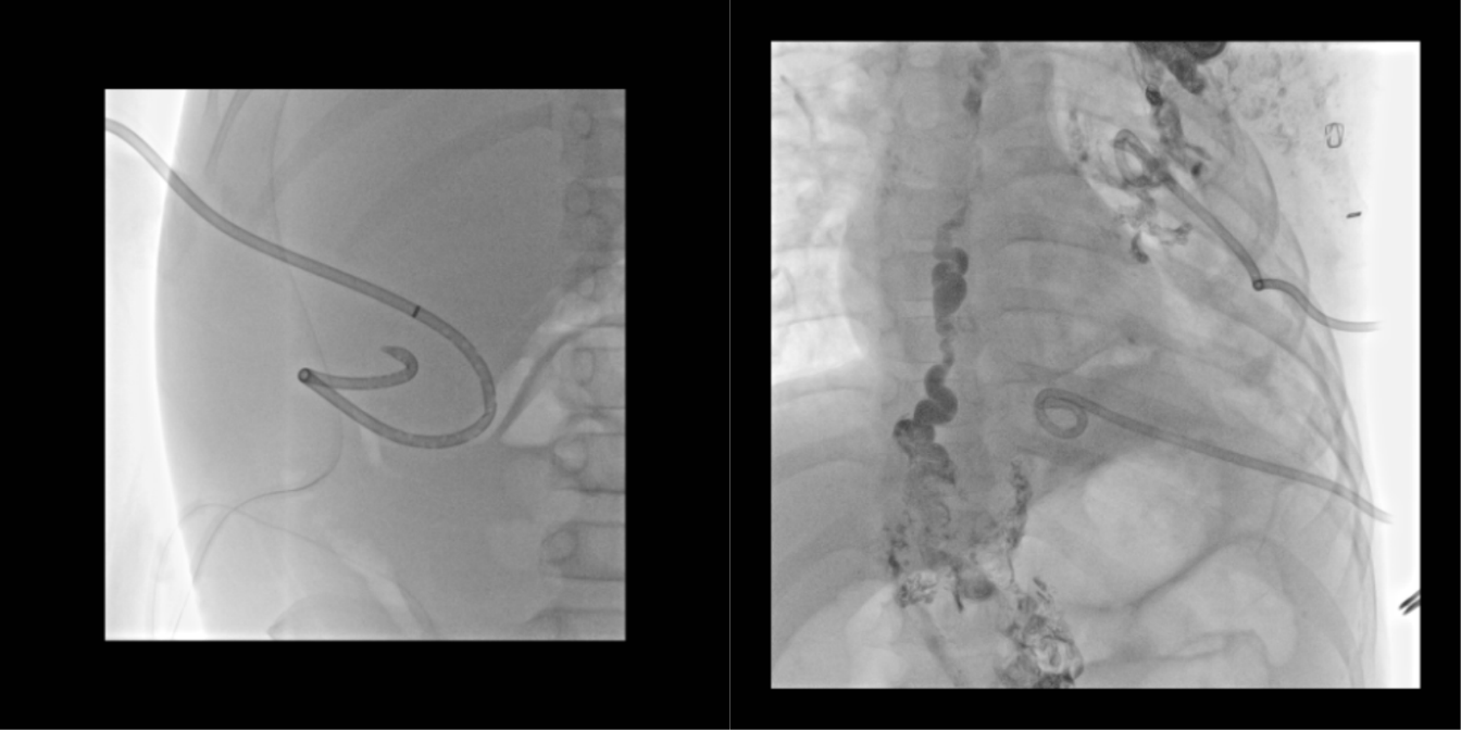 조직 생검 (Biopsy)