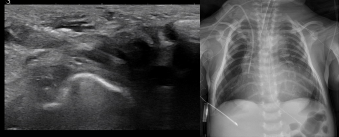 중심정맥관 삽입술 (Central Vein Catheter Placement)